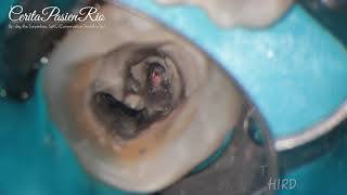 endodontic treatment c shaped and confluence canal mandibular molar perforation MTA one curve [upl. by Atikihs]