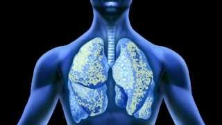 Effects of Asbestos on the Lungs [upl. by Ardiedal]