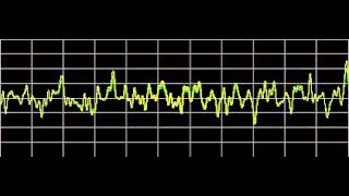 Cluster Headaches  Rife Frequencies [upl. by Zosema]