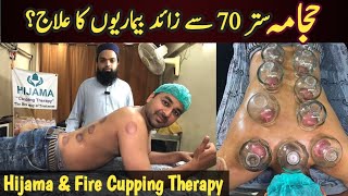 70 se bhi ziyada bimariyon ka ilaj Hijama cupping therapy  Benefits of hijamaFire Cupping Therapy [upl. by Rianna719]