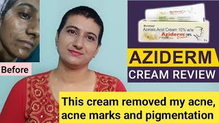 This cream removed my acne acne marks and pigmentation  Aziderm azelaic acid cream review telugu [upl. by Rawdon]