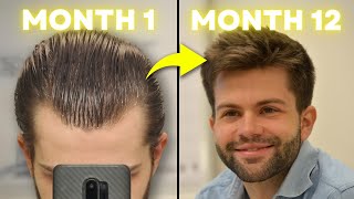 How I Regrew My Hair Using 3 Proven Treatments MonthbyMonth Results [upl. by Aissenav]