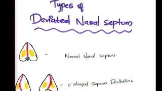 Types of deviated nasal septum [upl. by Adnawyt]