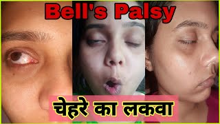 😔😭I was suffering from BELLS PALSY amp VESTIBULAR Disorder My Story Miss Beauty pie [upl. by Burtie58]