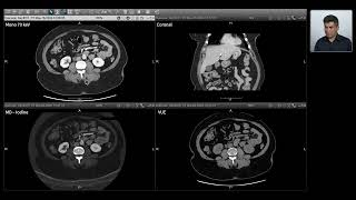 Spectral Imaging  Renal Lesion [upl. by Roderigo662]