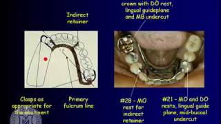 DENT 718 Removable partial dentures design considerations [upl. by Rudolfo434]