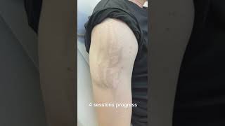 Laser tattoo removal results lasertattooremoval beforeandafter skincare tattoos satisfying [upl. by Nedrah40]