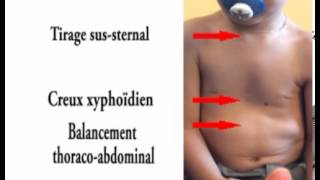 gêne respiratoire de bronchiolite ou asthme chez lenfant [upl. by Adnert]