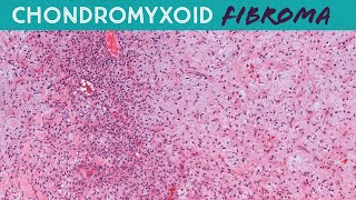 Chondromyxoid Fibroma CMF  Bone Pathology Basics Yale case 8 [upl. by Jandy67]