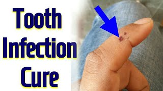 Single Acupressure Point For Infection In Teeth  Tooth DECAY  Tooth pain  Tooth Infection  Hindi [upl. by Ahseral]