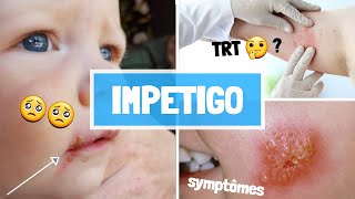 IMPETIGO  CAUSES  SYPMTOMES  COMPLICATIONS  TRAITEMENT [upl. by Suirrad844]