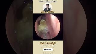 귀지형 콧물 부비동염 축농증 비염 코청소 이비인후과 rhinorrhea rhinitis sinusitis asmr ENT ENTdoctor [upl. by Ymmas]