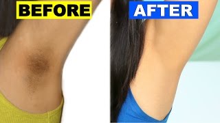 How To Lighten Dark Underarms Permanently  Skincare Routine  ShrutiArjunAnand [upl. by Leirea]