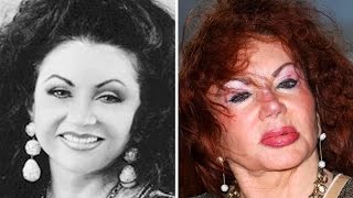 10 Shocking Plastic Surgery Fails [upl. by Riva713]