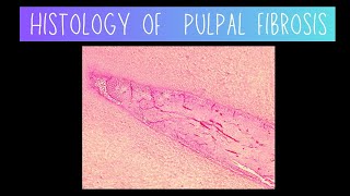 Histology of Pulpal Fibrosis  Dentistry [upl. by Ahseikan]