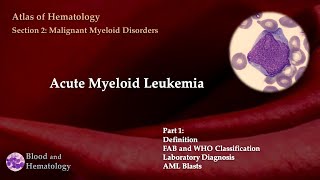 Acute Myeloid Leukemia AML  Part 1 [upl. by Eedia664]