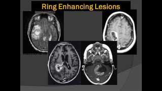 Brain Scans Lord of the Ring Enhancing Lesions 101 [upl. by Nosnevets]