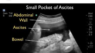 Ultrasound video showing Ascites ascites medicalmasti  ultrasoundvideoascites medicalmasti [upl. by Tirrag440]