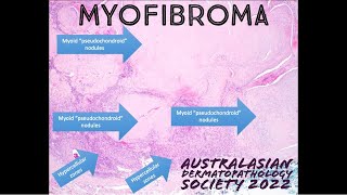 Myofibroma 101 explained in 5 minutes pathology dermpath dermatology [upl. by Ann]