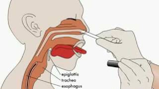 NurseReview Org Animation on Nasogastric Tube [upl. by Otte]