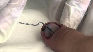 Trephining a nail to drain subungual haematoma [upl. by Jehiel]