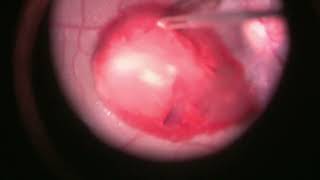 Vitrectomy for Sub ILM blood over macula  Sub ILM blood  Dr Manish Nagpal [upl. by Ydnas]