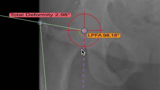 bonesetter deformity tool [upl. by Cheffetz]