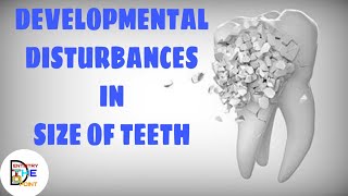 DEVELOPMENTAL DISTURBANCES IN SIZE OF TEETH [upl. by Brandtr827]