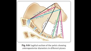 Obstetrics 121 Pelvis Pelvic Inlet Conjugate Diameter Anatomical True Obstetric Diagonal [upl. by Patsis]