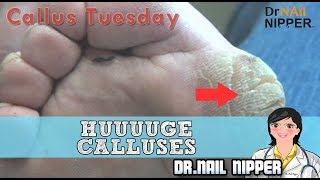 Absolute Monster Callus HUUUUGE Foot Calluses 26  Callus Tuesday Huge Callus [upl. by Adnahsar]