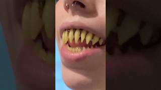 Why Is This FRIGHTENING Tooth Trend Is Taking Over 🧛🦷 [upl. by Nyahs553]