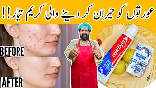 How To Remove Pimples Overnight  Acne Treatment  Remove Dark Spots 100 Effective  BaBa Food RRC [upl. by Maurita]