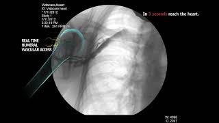 Humeral IO [upl. by Trojan]