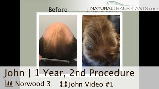 Norwood 3 Hair Transplant Results After Second Coat of Paint  Dr Blumenthal John [upl. by Filler37]