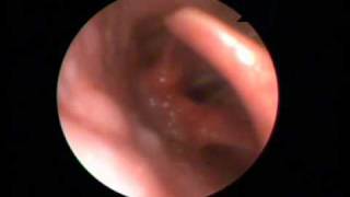 Vocal cord dysfunction syndrome  Video laryngoscopy [upl. by Affra]