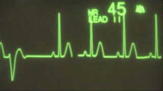 Sinus Rhythm with PVCs  ECG Training [upl. by Scot]