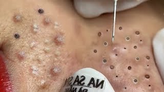 Treatment Of Blackheads And Acne Hidden Under The Chin [upl. by Darrel]