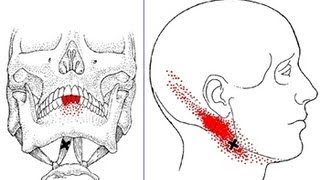 Jaw Neck Head and Teeth Pain from Digastric Muscle Trigger Points Referred Pain Patterns [upl. by Rizzo]