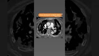 Pulmonary Embolism shorts shortsvideo viral [upl. by Llednor]