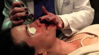 Laser treatment for Rosacea Birmingham Alabama  Cosmetic Dermatology [upl. by Annoik]