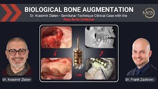 🔍 Dr Krasimir Zlatev  Semilunar Technique Clinical Case with the Easy Bone Collector EBC [upl. by Yelrebmik]