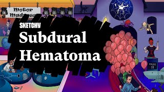 Subdural Hematoma SAH Part 1  Sketchy Medical  USMLE Step 1 [upl. by Paapanen538]