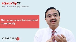 Can acne scars be removed completely  ClearSkinTips 27  ClearSkin Pune  In HINDI [upl. by Cherri]