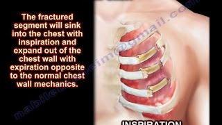 Flail Chest  Everything You Need To Know  Dr Nabil Ebraheim [upl. by Einnus]