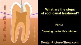 Root canal treatment steps  Part 2 [upl. by Nafis377]