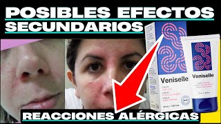 Cura de las venas varicosas ⛔😱❌CUIDADO❌🙀⛔ Cosas que nunca has oído hablar VeniselleMX varices [upl. by Roice251]