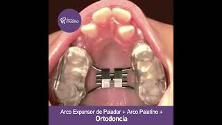 🟣 Arco expansor de paladar  Arco palatino  Ortodoncia  Clínica Odontológica Doctor Muelita  AQP [upl. by Lura]