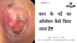 कान के पर्दे का ऑपरेशन👂eardrum hole repair 👂myringoplasty [upl. by Caundra]