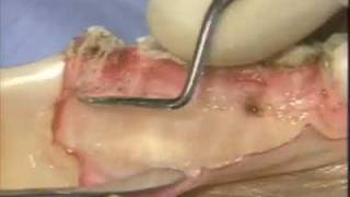 Introductory Periodontal Surgical Techniques The Apically Positioned Flap and Crown Lengthening [upl. by Sherrard]