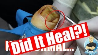 DID IT HEAL INFECETED INGROWN TOENAIL FOLLOWUP [upl. by Wilhelmine303]